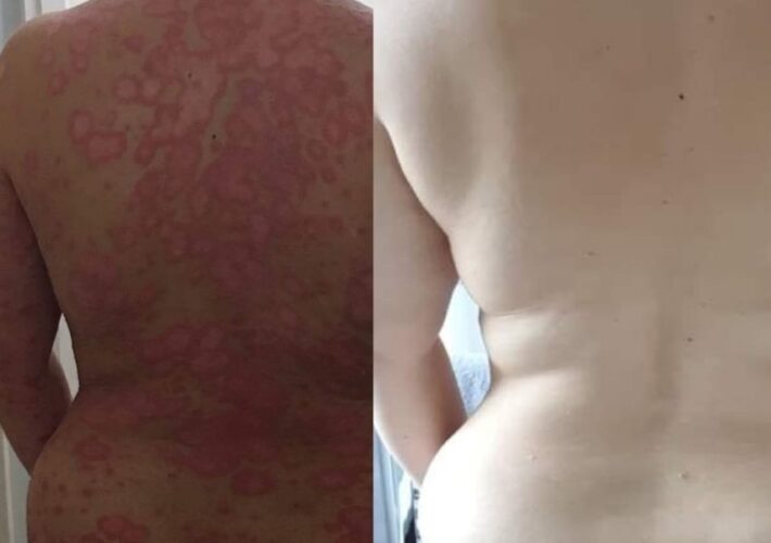 Heal Psoriasis: How Charlotte used Tropic Skincare products alongside her medication to heal her skin