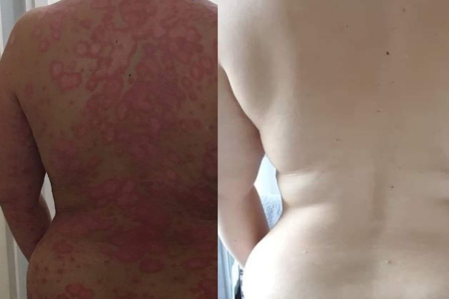 Heal Psoriasis: How Charlotte used Tropic Skincare products alongside her medication to heal her skin